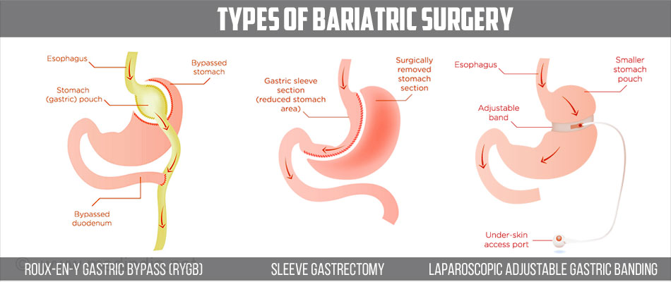 Tipos de cirugía bariátrica